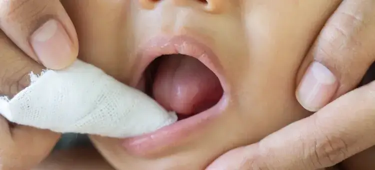 Zdjęcie Skuteczne sposoby na pleśniawkę u dziecka: unikaj bólu i dyskomfortu