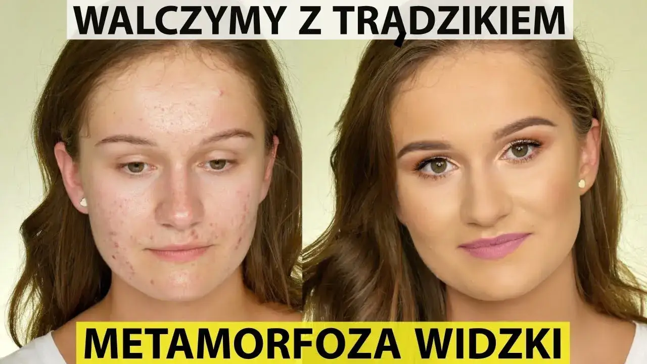 Zdjęcie Jak ukryć pryszcze makijażem i uzyskać naturalny efekt bez wysiłku