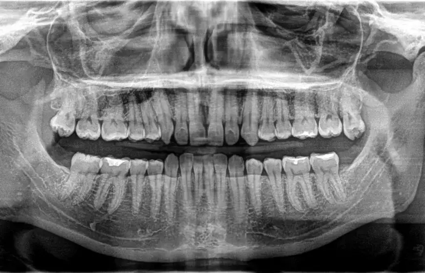 Zdjęcie RTG zęba: Co naprawdę widzi dentysta? Ukryta pr&oacute;chnica i torbiele