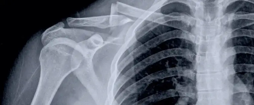 Zdjęcie Ile trwa rehabilitacja po złamaniu obojczyka? Poznaj kluczowe informacje
