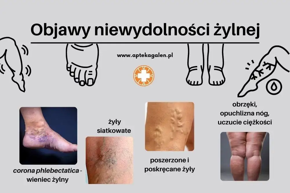Zdjęcie Niewydolność zastawek żylnych - poznaj skuteczne metody leczenia w 2025