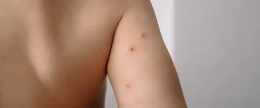 Zdjęcie Jakie są objawy mięczaka zakaźnego? Poznaj 7 najczęstszych symptomów