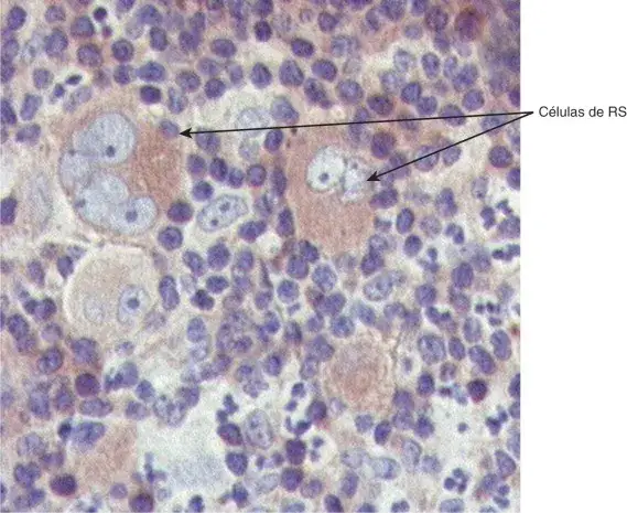 Zdjęcie Quién descubrió el linfoma no Hodgkin y su historia sorprendente