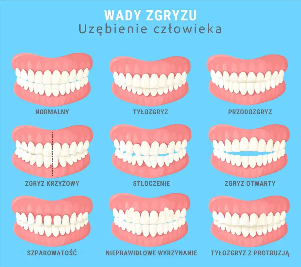 Zdjęcie Czy aparat zakłada się na wszystkie zęby? Odkryj, co warto wiedzieć
