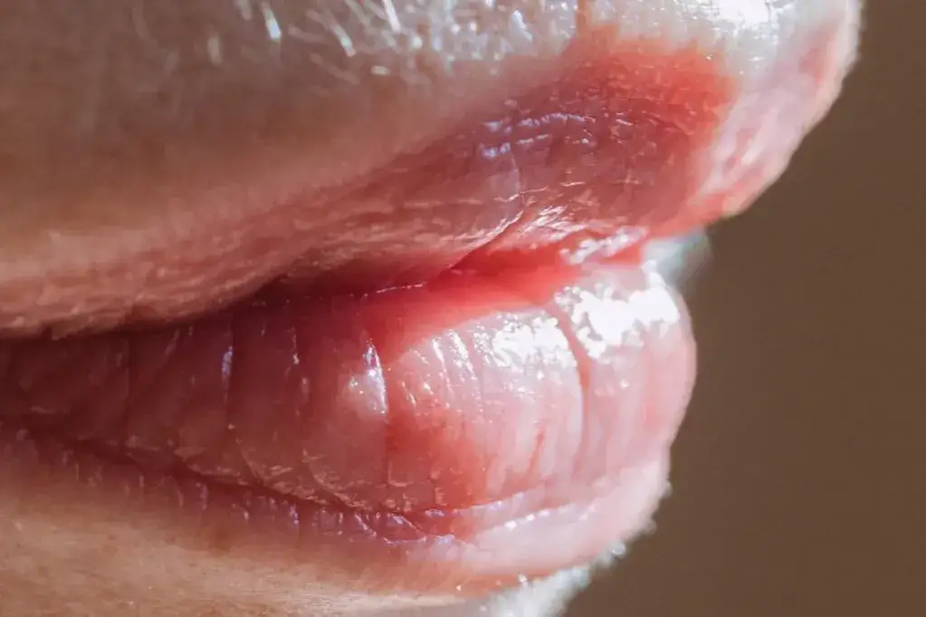 Zdjęcie Grudki po kwasie hialuronowym – jak długo znikają i co robić?