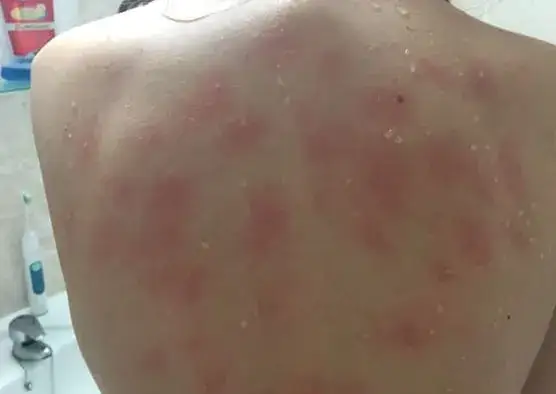 Zdjęcie Uczulenie na wodę z kranu objawy – jak rozpoznać niebezpieczne reakcje?