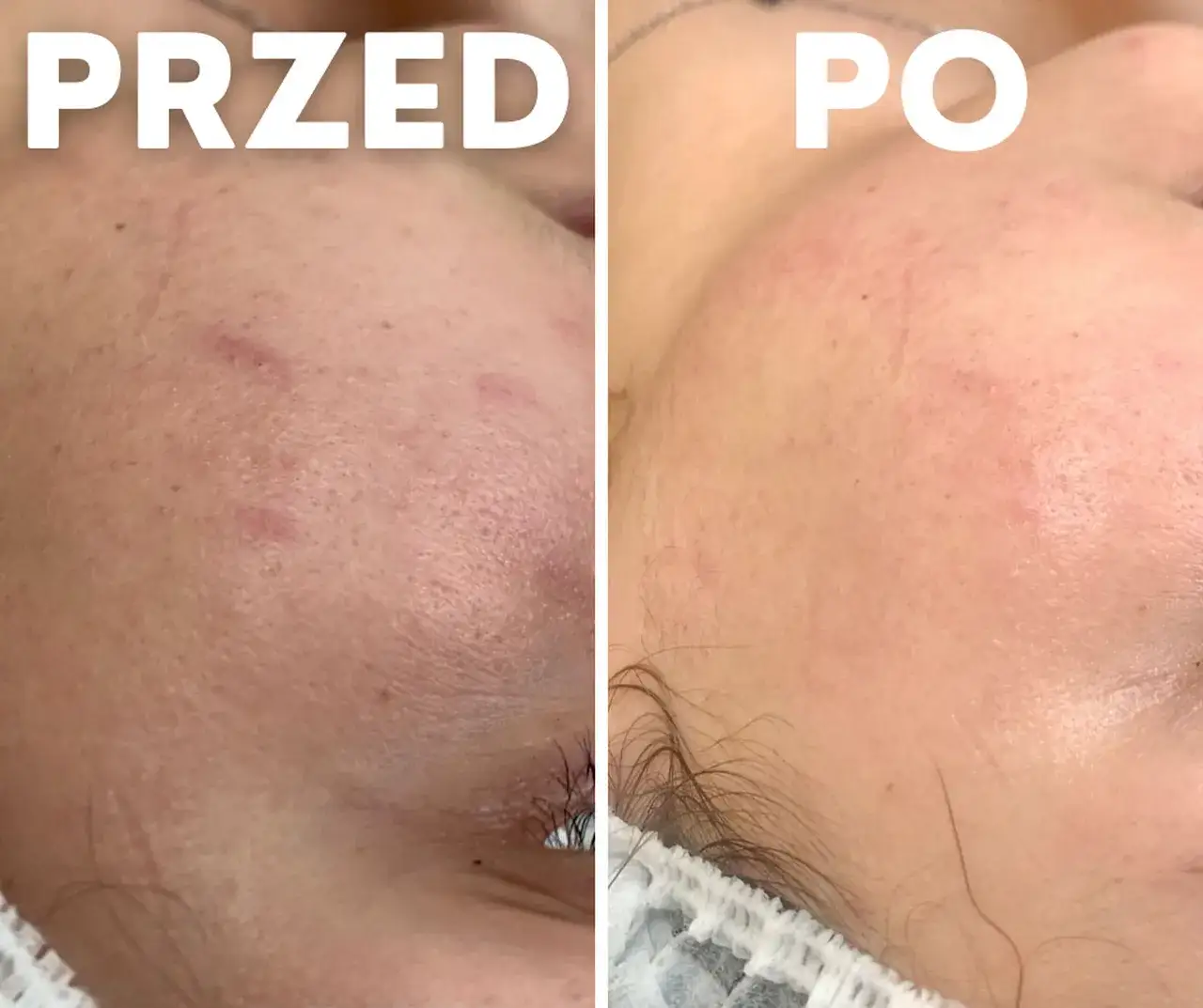 Zdjęcie Mikrodermabrazja diamentowa jak często? Odkryj idealną częstotliwość zabiegów