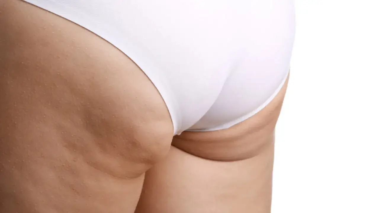 Zdjęcie Jak ukryć cellulit skutecznie i zyskać pewność siebie w plażowym stroju