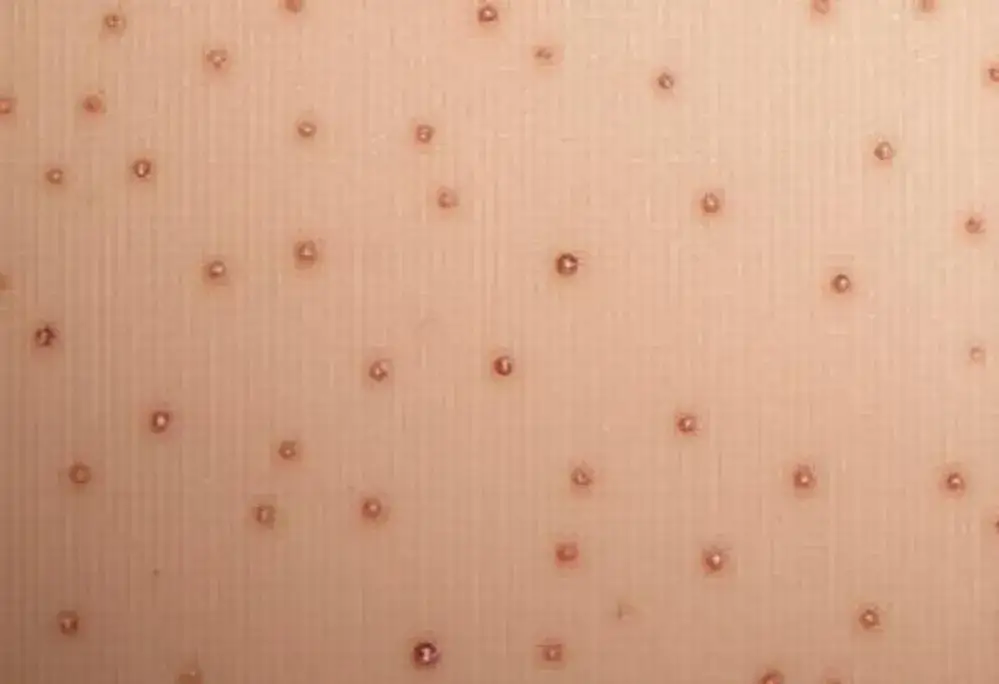 Zdjęcie Grudki po kwasie hialuronowym: kiedy znikną i co robić?