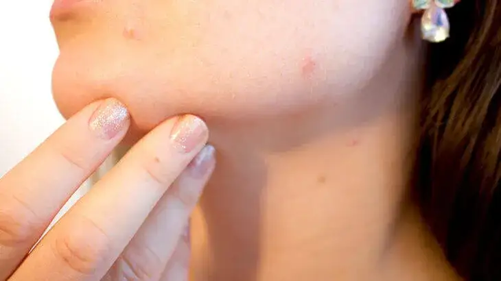 Zdjęcie Czy alergia i uczulenie to to samo? Odkryj kluczowe różnice