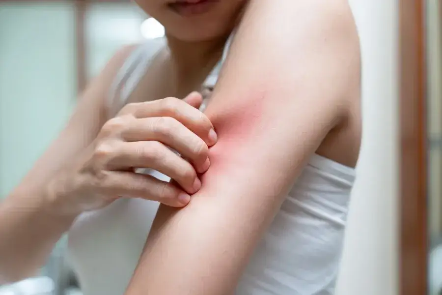 Zdjęcie Alergia na nikiel: Objawy, przyczyny i jak sobie z nią radzić?