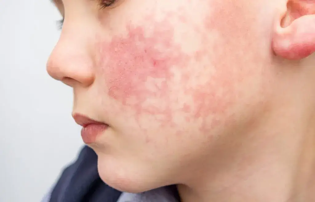 Zdjęcie Alergia na pleśń u dzieci – jak rozpoznać objawy i unikać problemów