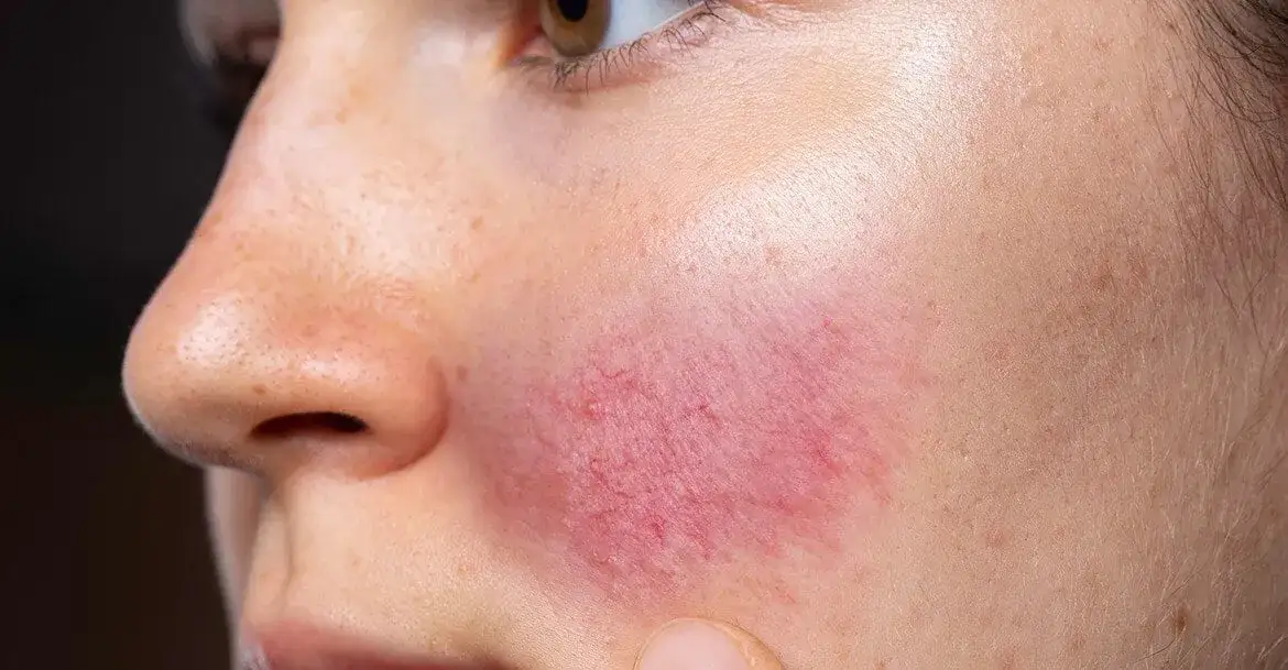 Zdjęcie Trądzik r&oacute;żowaty: kompleksowy poradnik pielęgnacji i leczenia