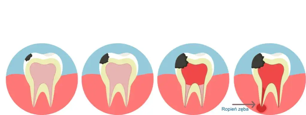 Zdjęcie Jak skutecznie wyciągnąć ropę z zęba i uniknąć bólu?
