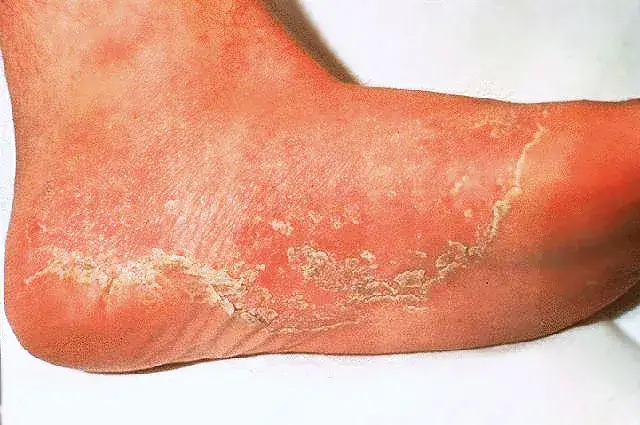 Zdjęcie Grzybica jelit objawy skórne – jak rozpoznać i leczyć dolegliwości?