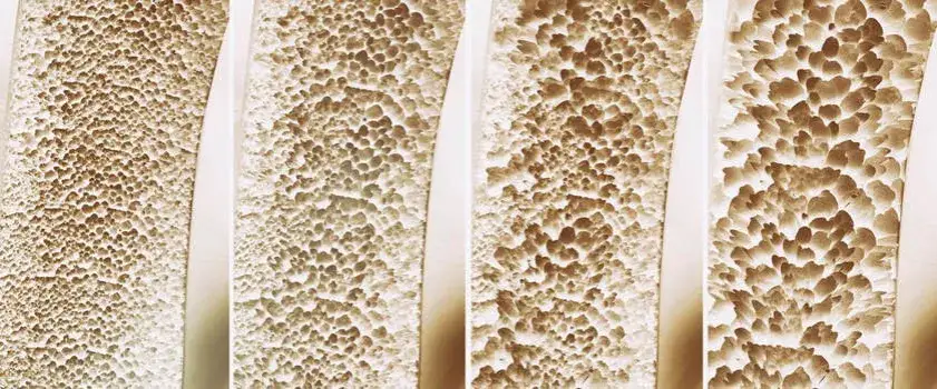 Zdjęcie Osteoporoza przyczyny: Jak uniknąć utraty gęstości kości?