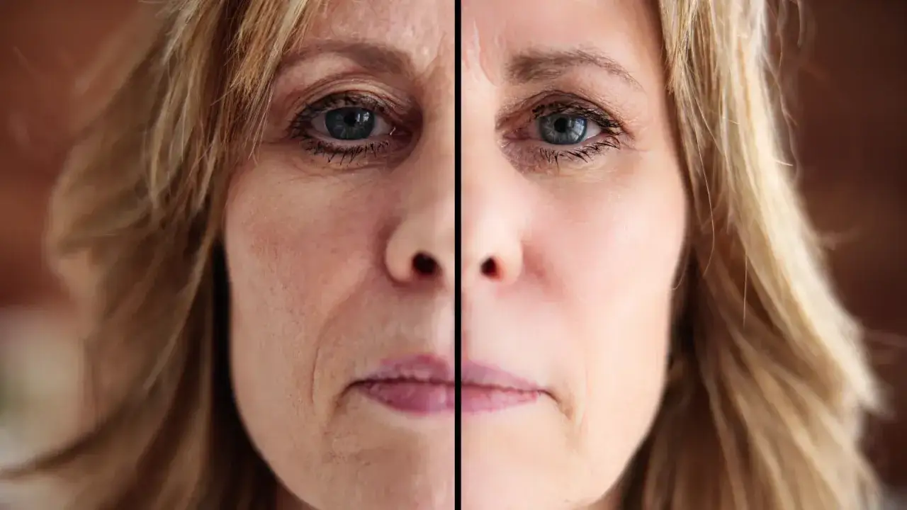 Zdjęcie Opadająca powieka po botoksie? Sprawdź, jak szybko wr&oacute;cić do formy