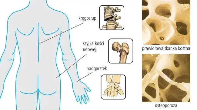 Zdjęcie Osteoporoza przyczyną: poznaj czynniki ryzyka i jak ich unikać