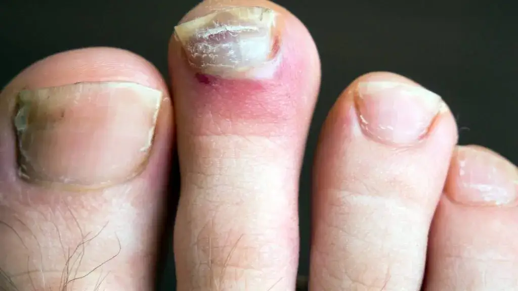 Zdjęcie Wrastający paznokieć jaki lekarz – wybór specjalisty i skuteczne leczenie