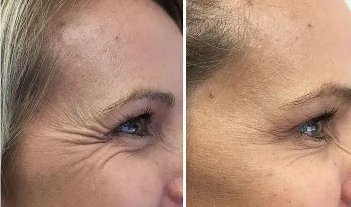 Zdjęcie Jak długo utrzymuje się botoks na czoło? Poznaj prawdę o efektach