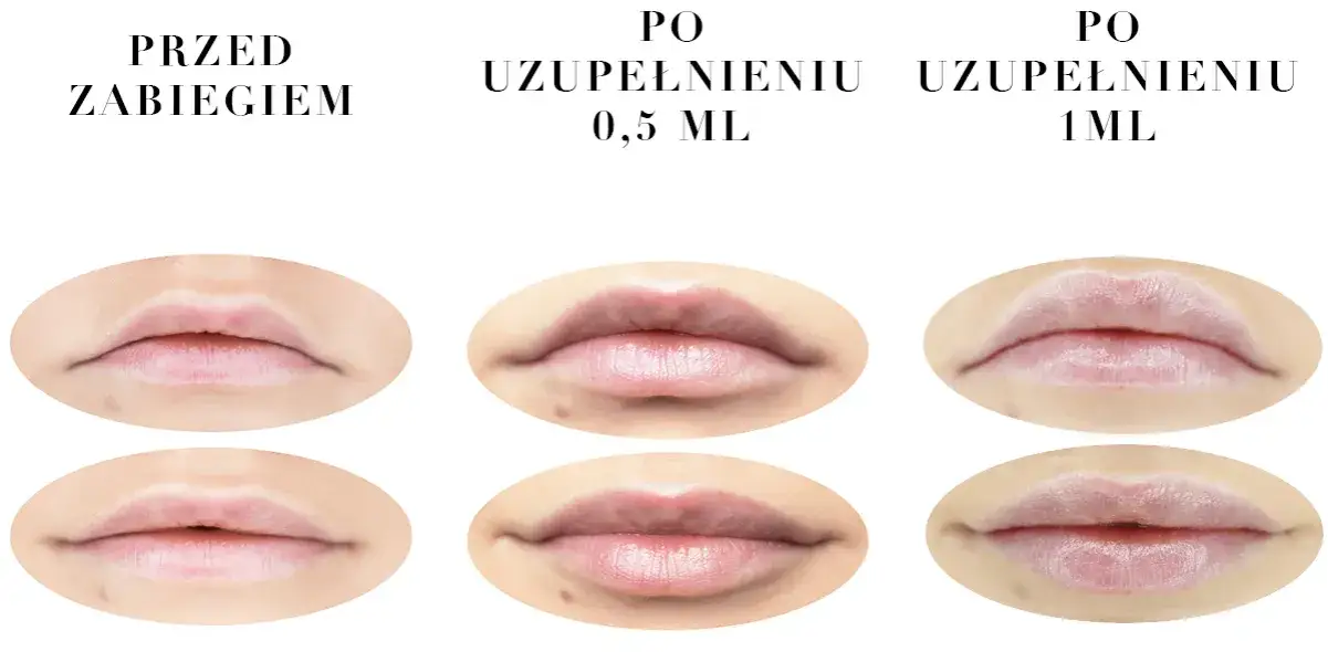 Zdjęcie 0,5 ml kwasu hialuronowego: Ile kosztuje i jakich efektów się spodziewać?