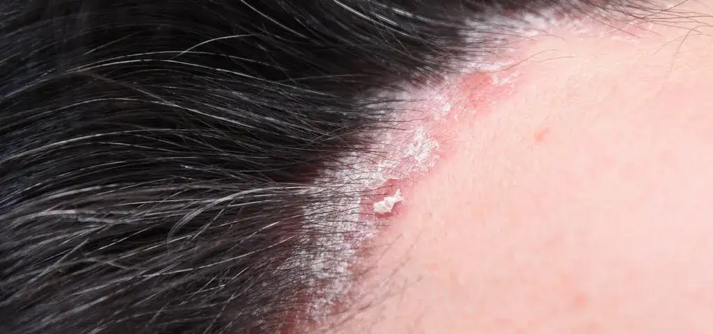 Zdjęcie Ile goi się strup po pryszczu? Unikaj błędów w pielęgnacji skóry