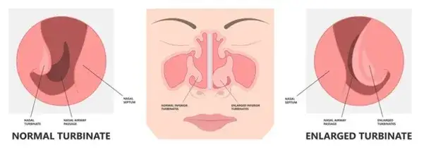 Zdjęcie Przerost małżowin nosowych objawy: Jak je rozpoznać i leczyć