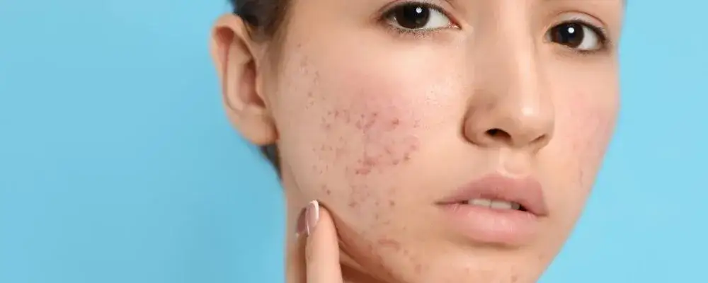 Zdjęcie Jakie kosmetyki do cery tłustej pomogą uniknąć błyszczenia i trądziku