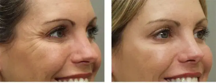 Zdjęcie Kiedy botox zaczyna działać? Oczekuj efektów już po kilku dniach