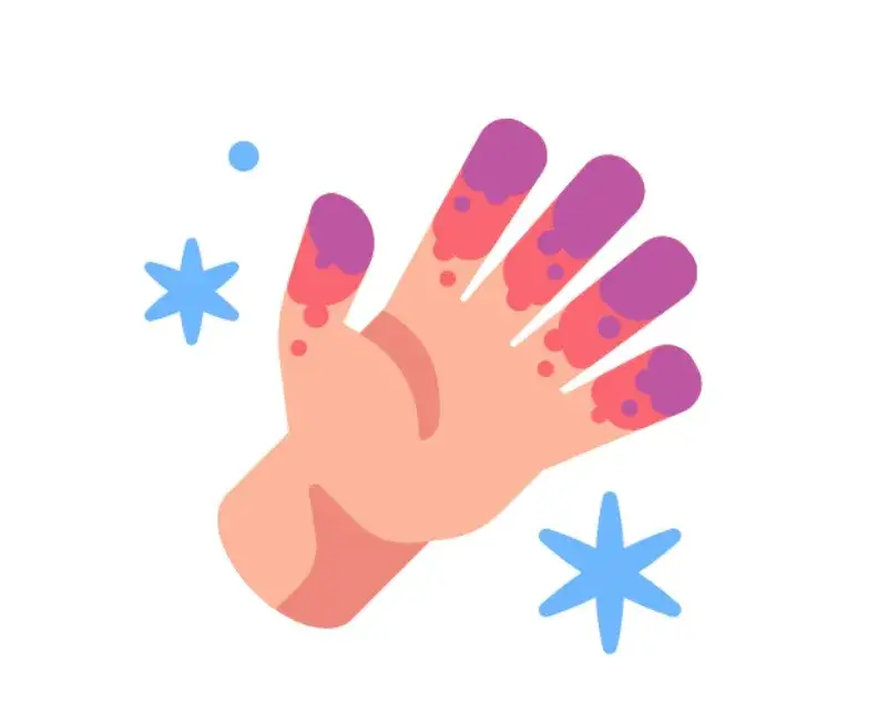 Zdjęcie Odmrożenia jak postępować: Kluczowe kroki, by uniknąć powikłań