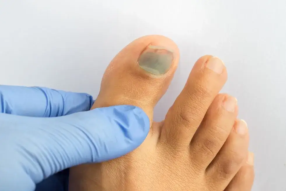 Zdjęcie Jak leczyć czarny paznokieć: skuteczne metody na ból i dyskomfort