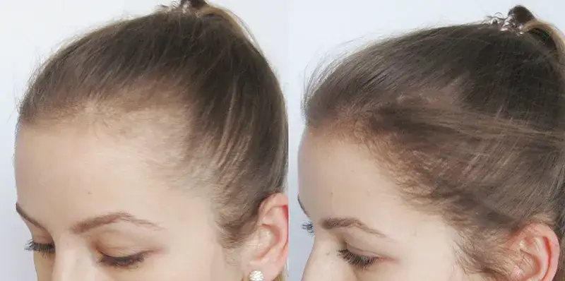 Zdjęcie Jak ukryć zakola u dziewczyn – najlepsze fryzury i triki stylizacyjne