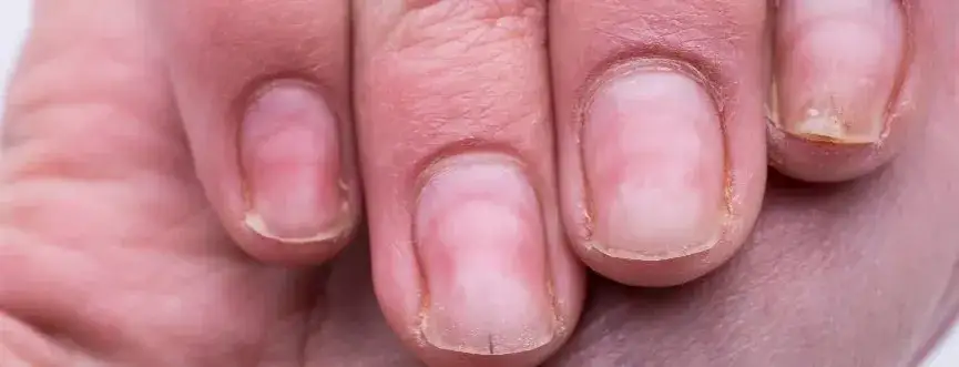 Zdjęcie Uczulenie na hybrydę: objawy, przyczyny i jak sobie radzić