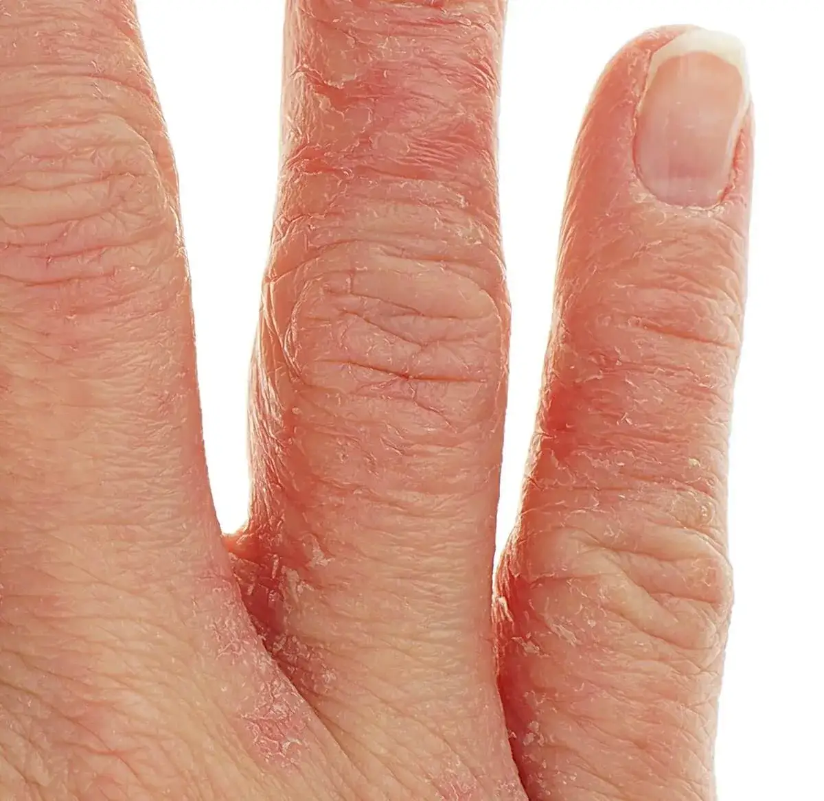 Zdjęcie Alergia na nikiel w jedzeniu: objawy, diagnoza i dieta
