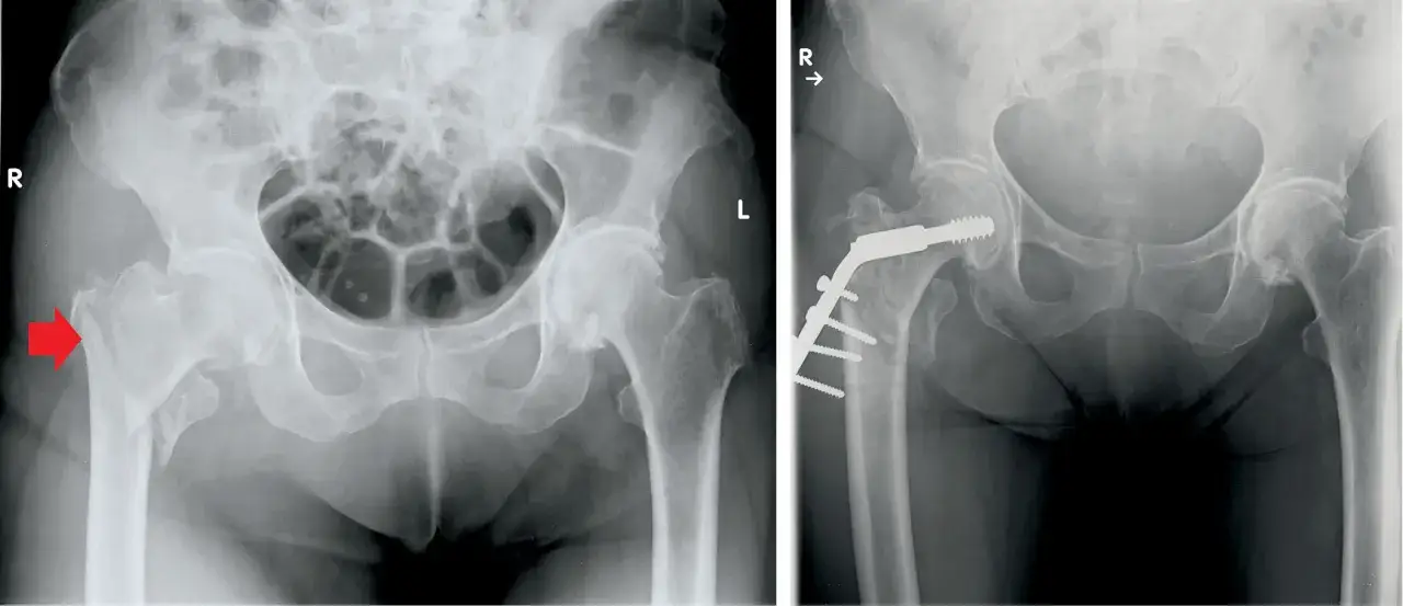 Zdjęcie Złamanie kości udowej: ile czasu trwa zrastanie? Poznaj fakty
