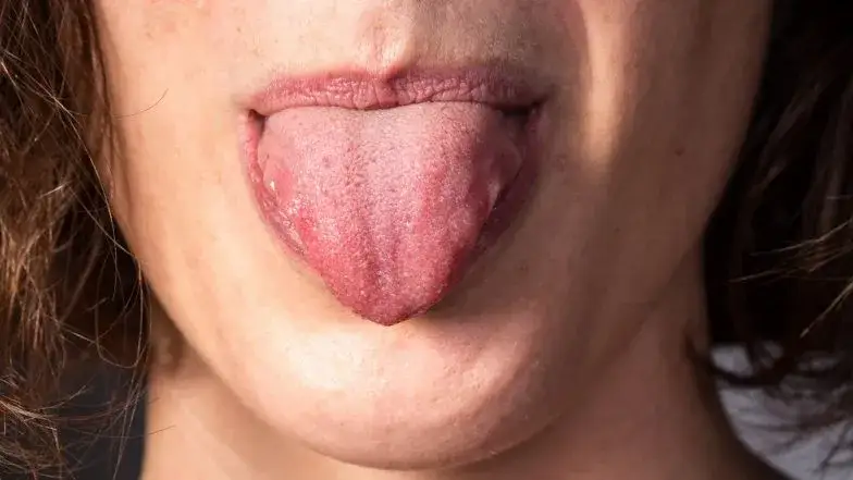 Zdjęcie Pryszcz na języku co zrobić? Skuteczne sposoby na ulgę i leczenie
