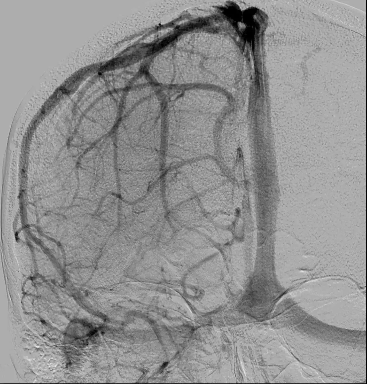 Zdjęcie Zatoka strzałkowa górna - kluczowa rola w anatomii mózgu i zdrowiu