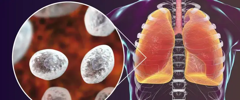 Zdjęcie 7 najgroźniejszych objawów zapalenia płuc, które musisz rozpoznać szybko