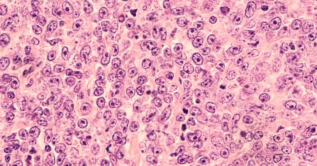 Zdjęcie Chłoniak jakie badania krwi - kluczowe testy i ich znaczenie w diagnozie