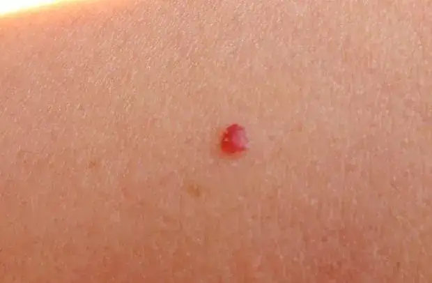 Zdjęcie  Naczyniaki rubinowe jako niepokojące znamiona na skórze