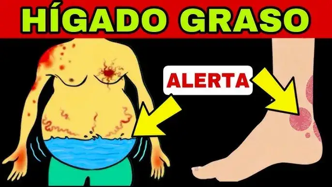 Zdjęcie S&iacute;ntomas del h&iacute;gado graso: &iquest;Est&aacute;s ignorando se&ntilde;ales alarmantes?