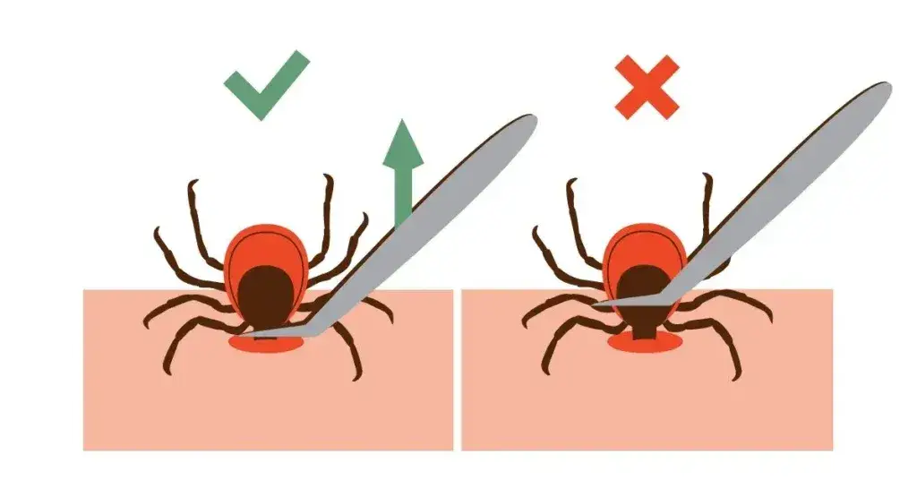 Zdjęcie Jak rozpoznać kleszcza w skórze i uniknąć poważnych zagrożeń