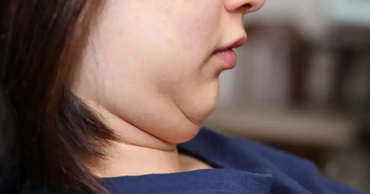 Zdjęcie Opuchnięcie twarzy przyczyny: najczęstsze powody i co z tym zrobić