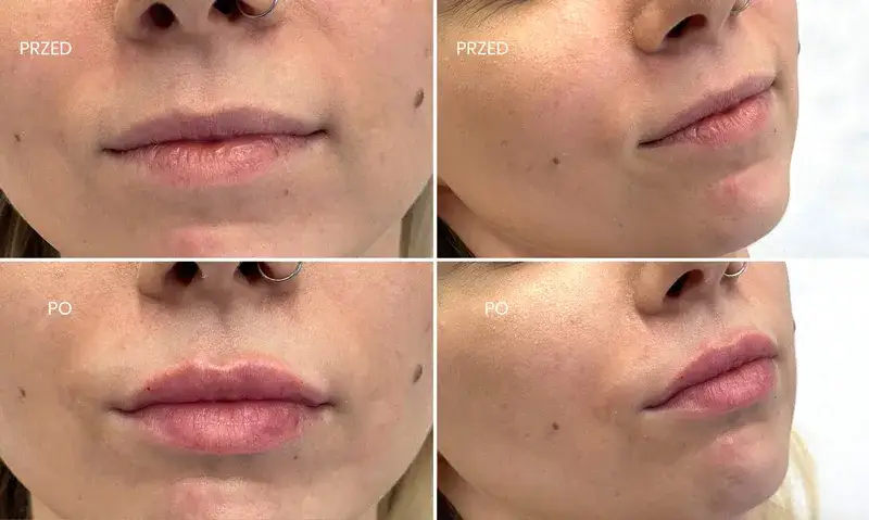 modelowanie ust kwasem hialuronowym efekty cena