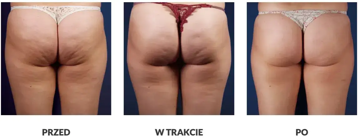 endermologia lpg alliance efekty, fala uderzeniowa cellulit przed i po