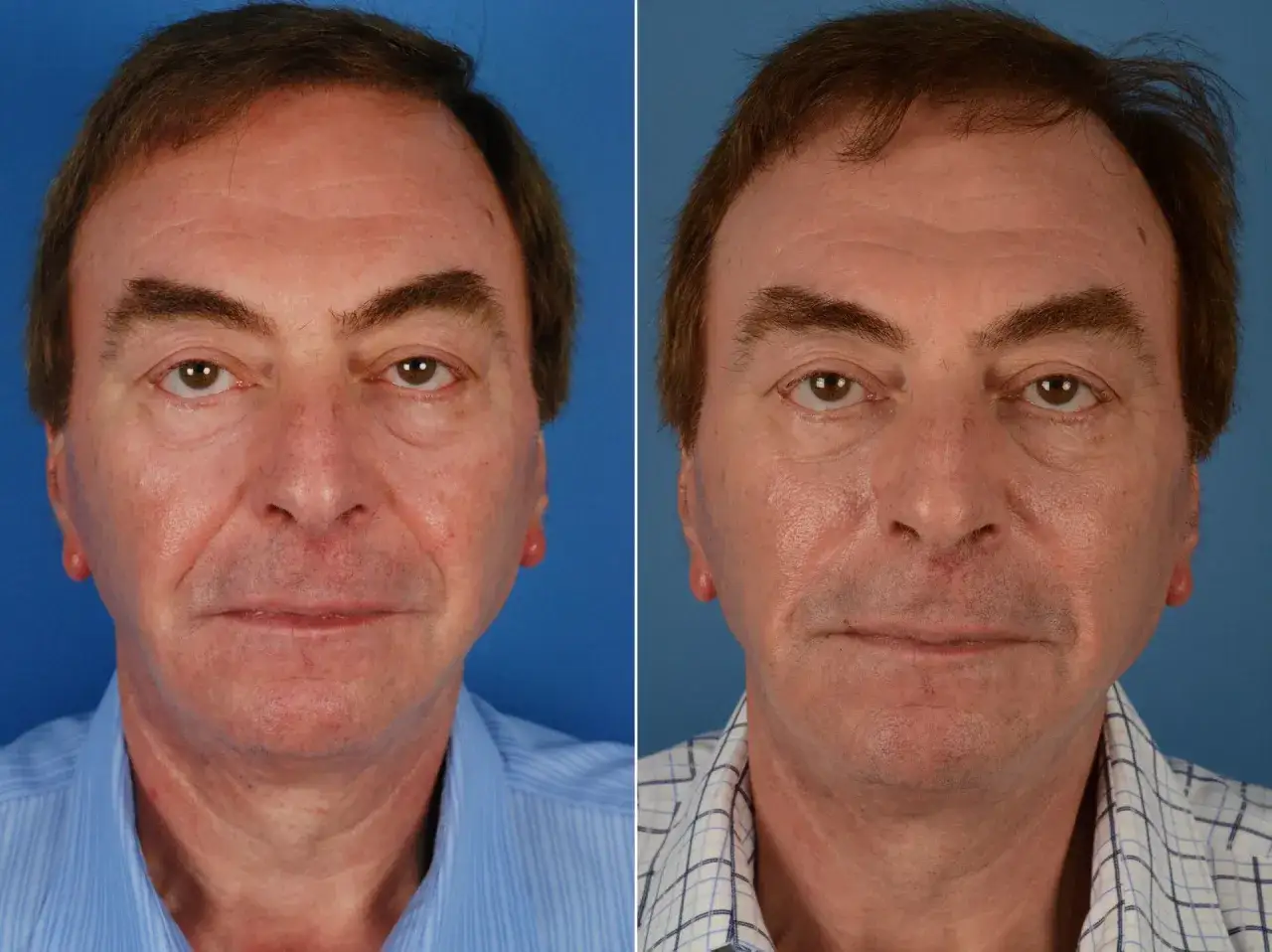 kobieta przed i po wypełnianiu bruzd nosowo-wargowych