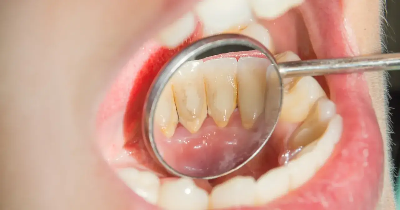 Widok jamy ustnej z widocznym kamieniem nazębnym na zębach, kt&oacute;ry wygląda, jakby kamień nazębny sam odpadał.