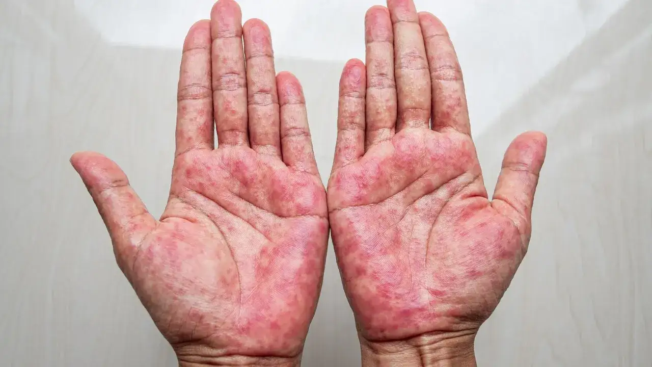 czerwone dłonie od wewnątrz medycyna