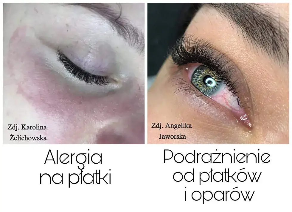 r&oacute;żnice między alergią a podrażnieniem oczu po rzęsach