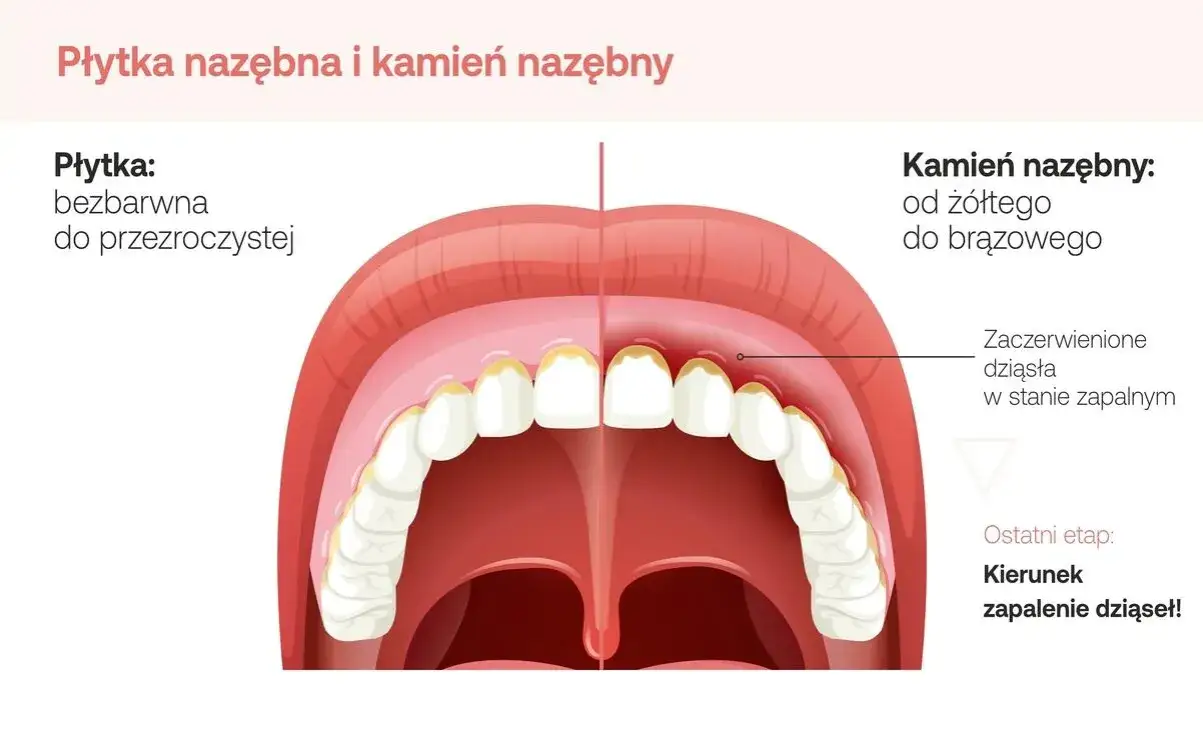 przyczyny zapalenia dziąseł płytka kamień nazębny